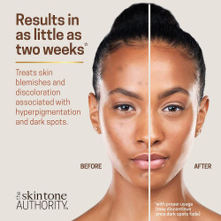 Ambi Skincare Fade Cream for Normal Skin | Dark Spot Remover for Face and Body | Treats Skin Blemishes & Discoloration | Improves Hyperpigmentation | Corrector | 2 Ounce